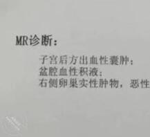 陪酒骚妈卵巢癌晚期，还有几个月，还有人玩吗