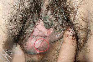 丈母娘的阴道疱疹